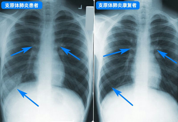 03_支原體肺炎.jpg